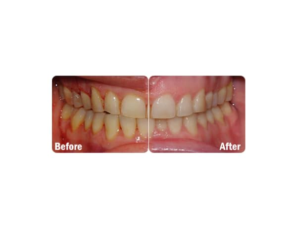 ProBiora Oral Probiotics for Teeth and Gums, 30 Mint Tablets Y12323